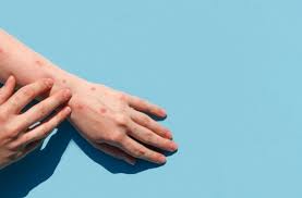 Monkeypox Disease: Symptoms, Safety Tips And Precautions | XYZspot